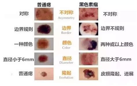 臉部 痣|痣是什麼？會變成黑色素瘤？7種一定要除的痣